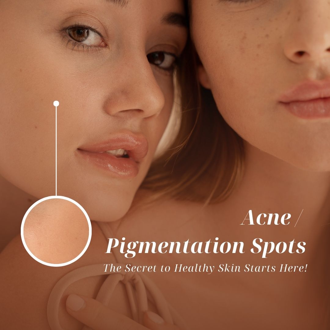 Ακμή - Πανάδες en